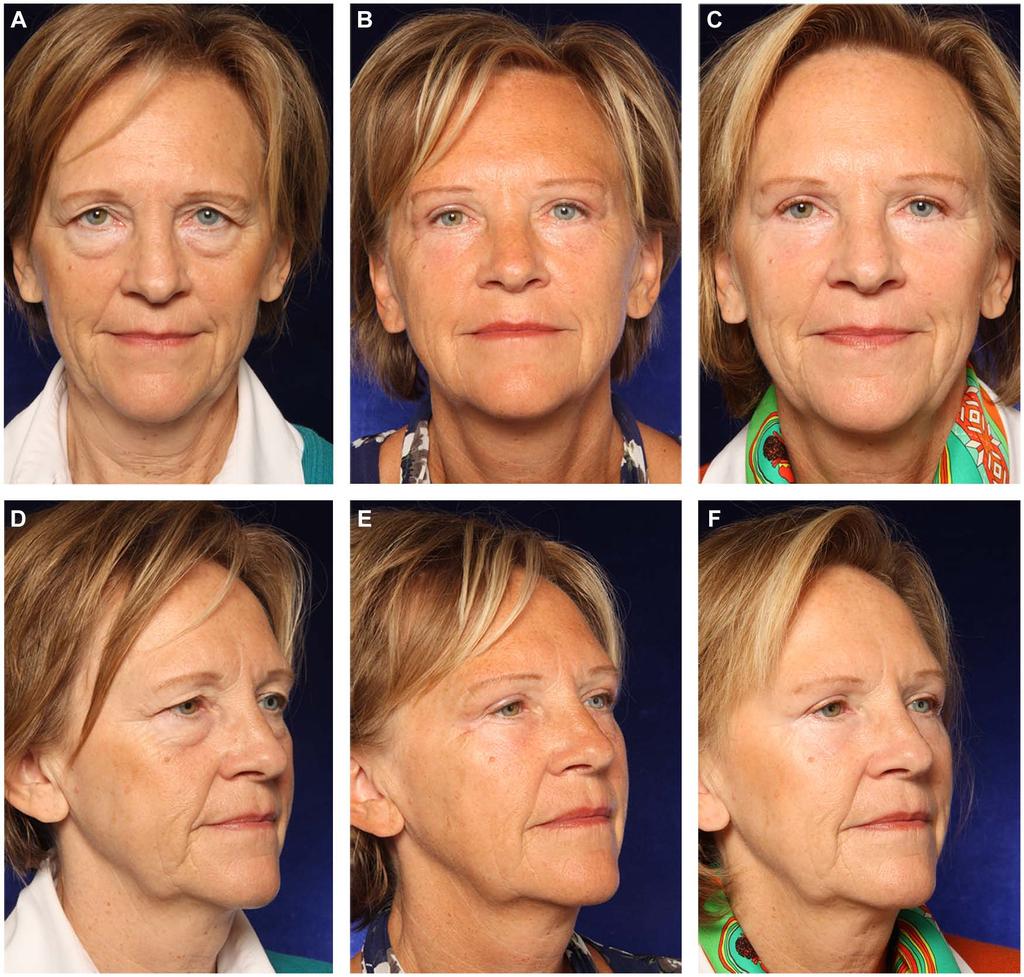 346 Aesthetic Surgery Journal 33(3) Figure 6. (A, D) This 54-year-old woman presented for upper and lower blepharoplasty.