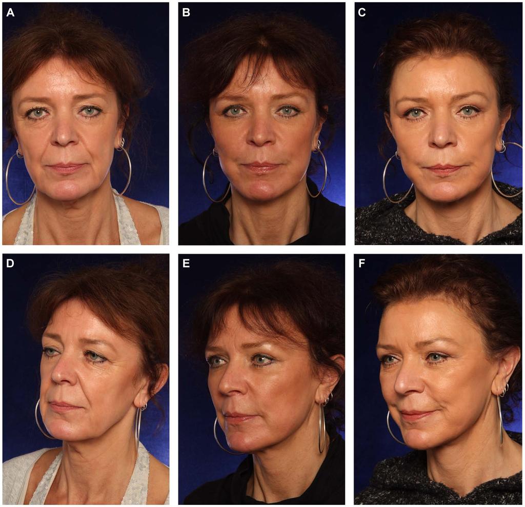 Tonnard et al 347 Figure 7. (A, D) This 49-year-old woman presented for total facial rejuvenation.