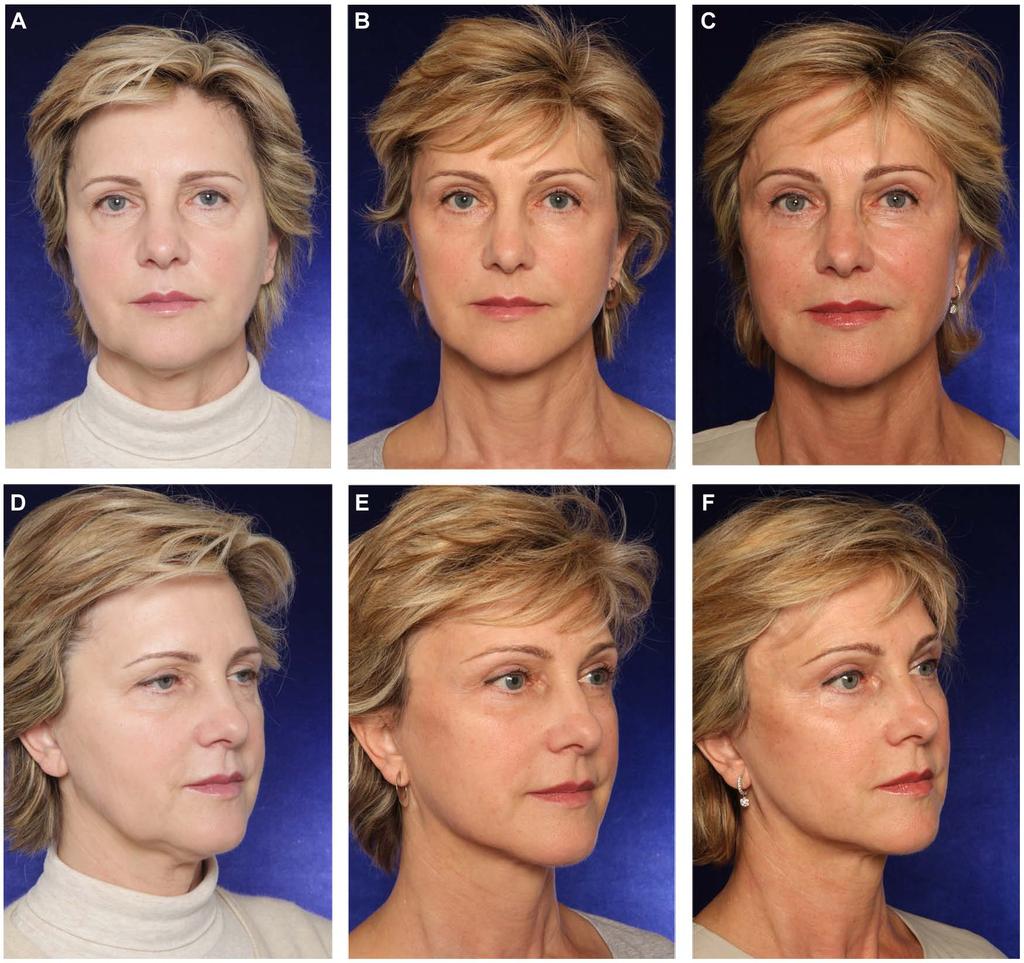 348 Aesthetic Surgery Journal 33(3) Figure 8. (A, D) This 58-year-old woman presented for total facial rejuvenation.