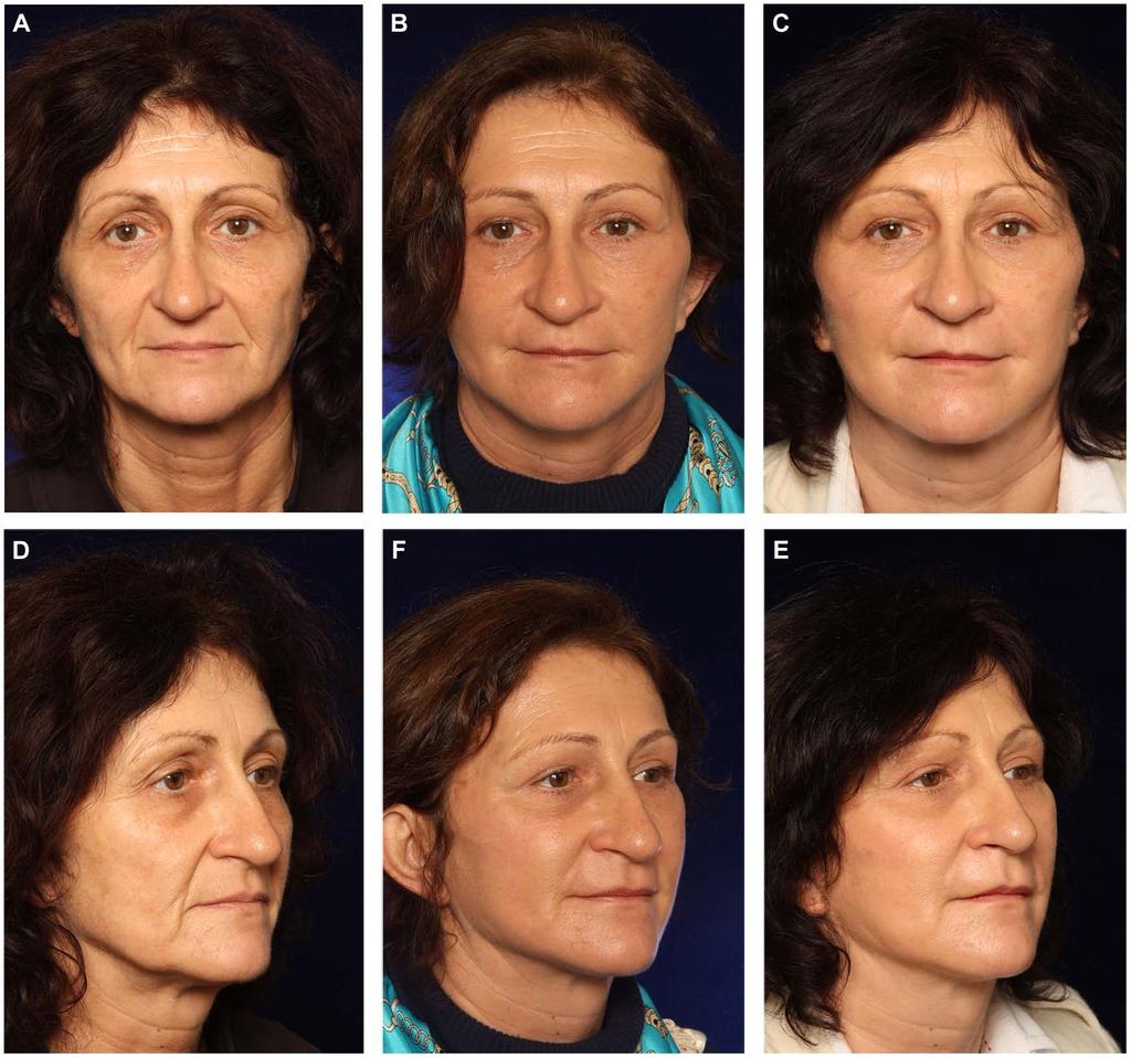 Tonnard et al 349 Figure 9. (A, D) This 48-year-old woman presented for total facial rejuvenation.