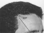 Irregular and Sinuous Anterior Hairline: Prior Technique Refinement and Male and Female Trace Parameters Fernando Basto, MD Graças, Recife, Brazil We carefully analyzed 43 people with no baldness, of