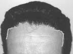 could then more accurately mimic those of their natural non-bald counterparts. Methods For male patients, the trace starts from a point located approximately 1.