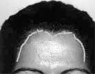 Irregular and Sinuous Hairline continued from page 15 Figure 2D. No baldness female patient: Pay attention to a bigger group of hair in a V shape in the central forehead. Figure 3.