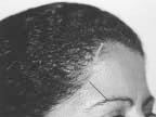 Female patient: Notice the drawing designed irregularly according to the technique. Figure 2E. The distance between the tail-end of the eyebrow and temporal hairline is shorter in females. Figure 4.