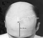 4% of the cases there was a larger amount of hair in a V shape in the central forehead. 4. The temporal entrances, for the most part, are presented in 84.