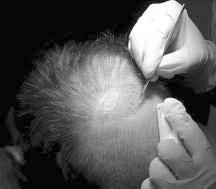 Pre-op we encourage all patients with tight scalps to push the donor scalp up and down with their palm to increase laxity. The strip is removed under 1% xylocaine.
