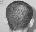 Hair Transplant Forum International Volume 15, Number 1 Whorl on Scalp of Thai Monk and Nun Viroj Vong, MD Bangkok, Thailand Whorls on scalps are called Quan in Thailand.