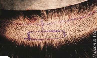 Hasson & Wong Lateral Slit Technique in Hair Transplantation Natural hair transplant results, minimized scarring The evolution of follicular unit hair transplants, which involves transplanting hair