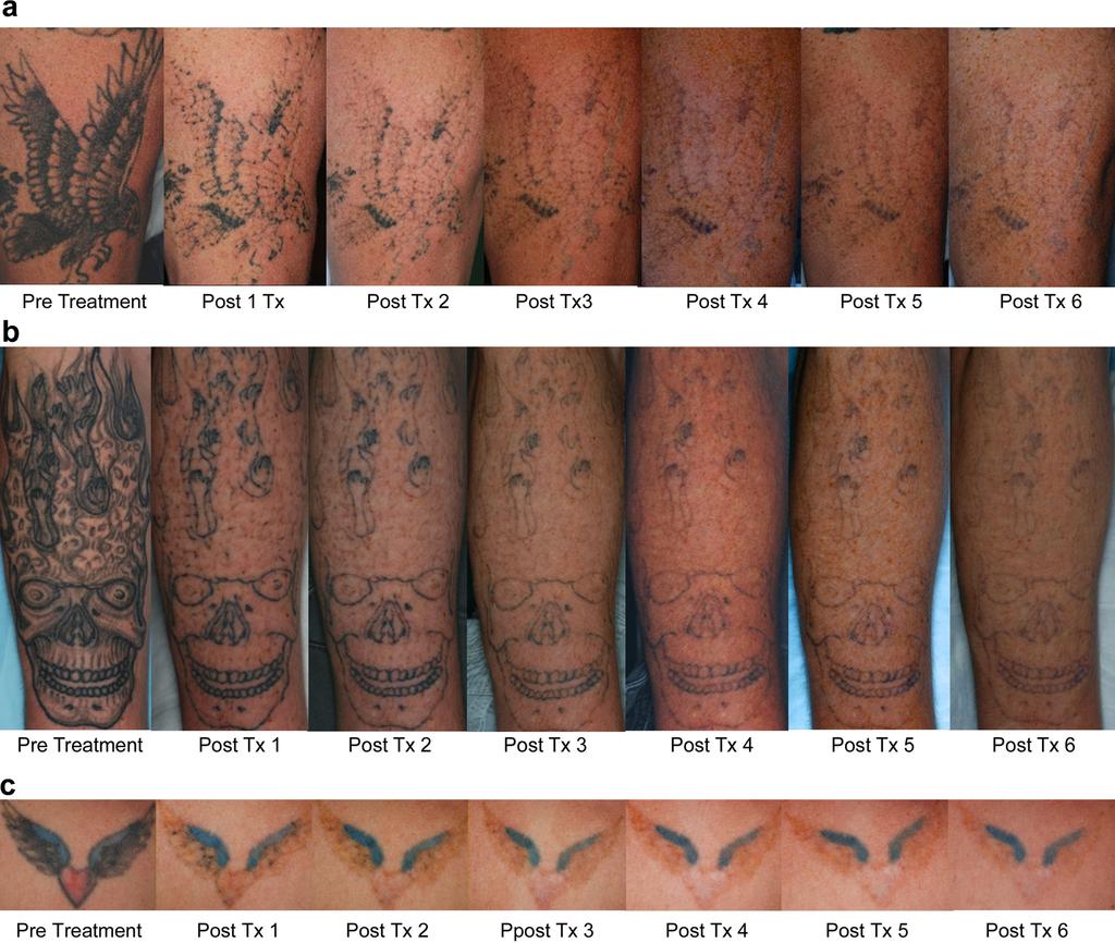 SPOT SIZE AND TATTOO REMOVAL 625 Fig. 2. Tattoos pre-treatment, and after each of six treatments demonstrating progressive clearance.