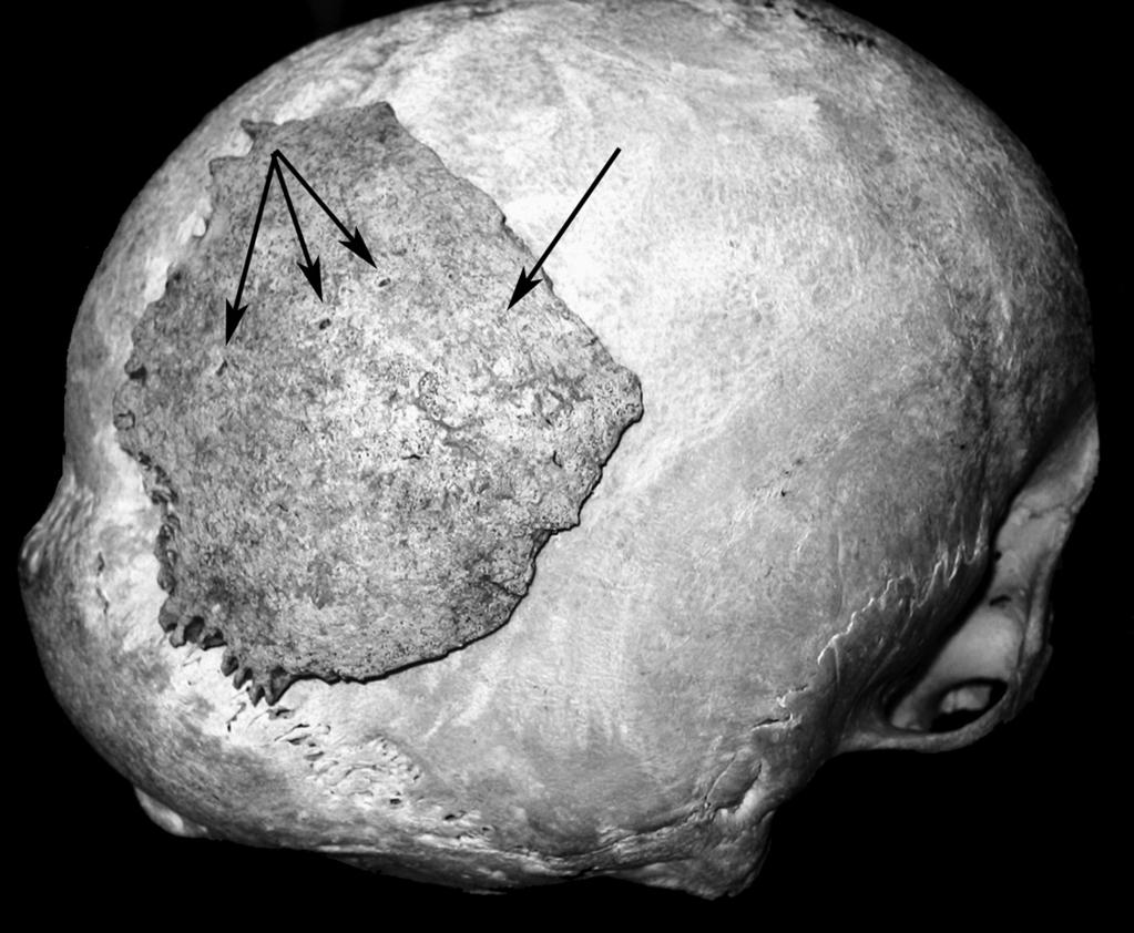The parietal on a modern skull, posterior view: emplacement of disarticulation with the traces of scratching and impact of pointed instruments with the 3 holes (arrows) (picture A.