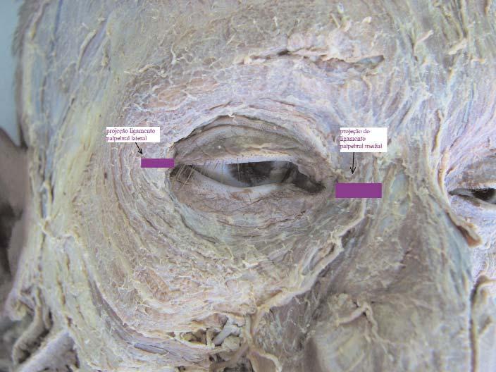 197 The sub orbicular ocular fat (SOOF) is located on top of the lowest portion of the zygomatic bone and under the orbicularis muscle.