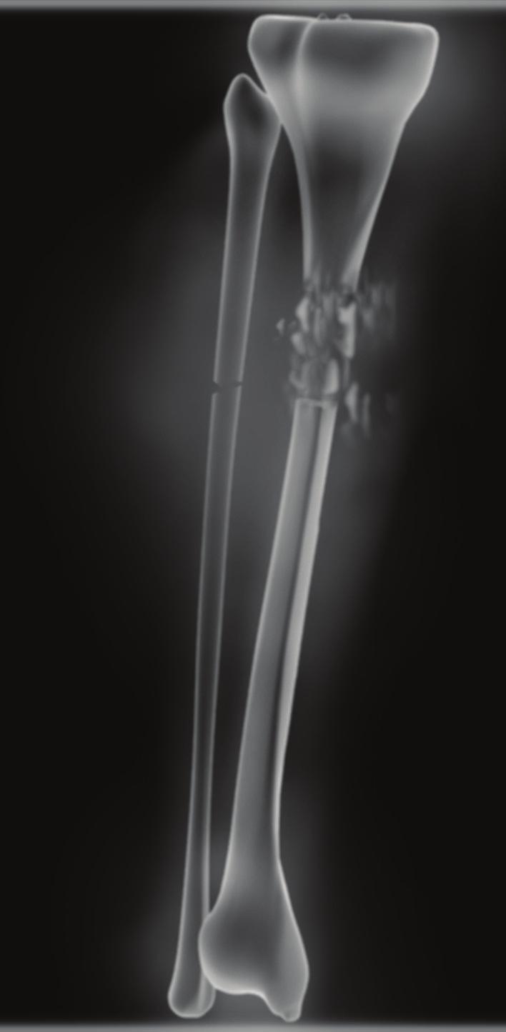 Doctors can help bones heal from breaks. But in some cases, like the one we can see in the X-ray above, a cast alone is not enough! Bone Activity 2 Doctor, Doctor!