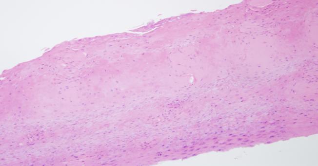 Typical teat tissue peeling (perakeratosis with nucleated