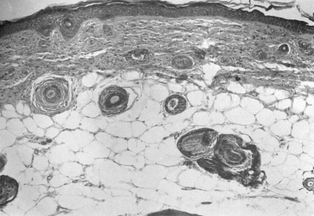 One Follicle shows growth Activity, while 4 other Follicles (with their Papillac attached)