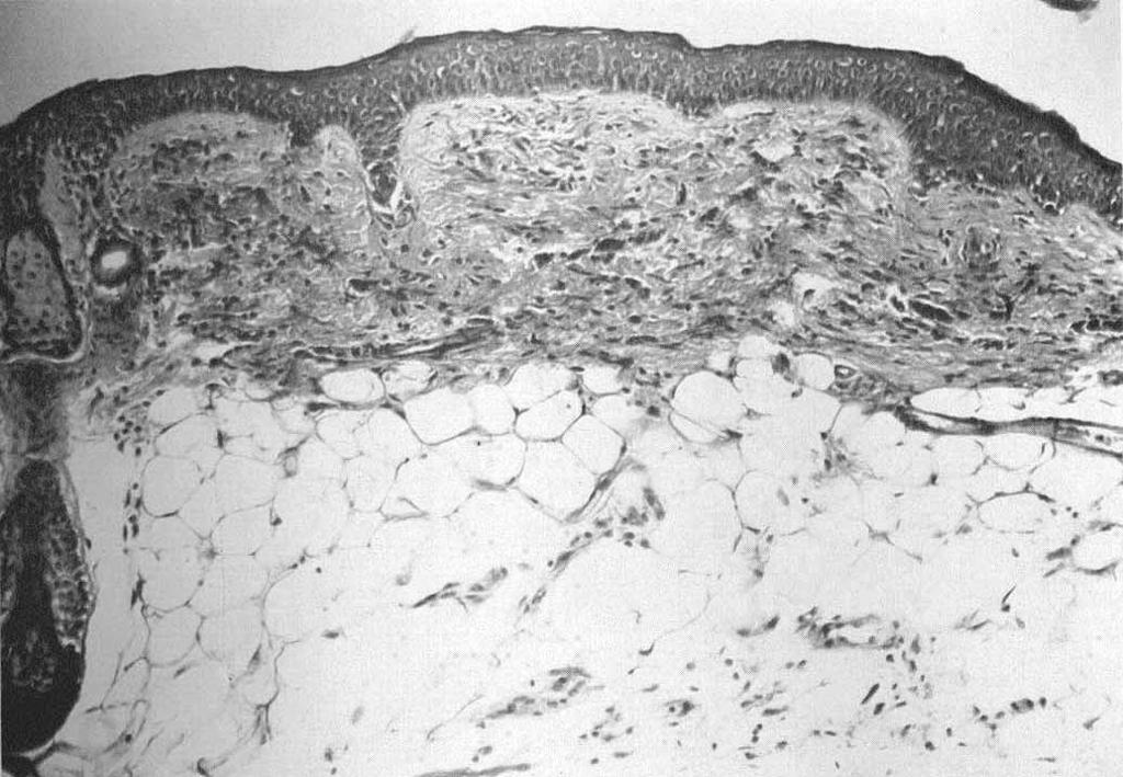 4-' S -a -., 'aa -. 4 - --1 5 ' - 4- hyperchromatic epithelial nuclei. These sacs contained abnormally thin hair shafts.