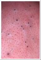 Disorders of the Sebaceous Glands Condition/ Disease/Disorder
