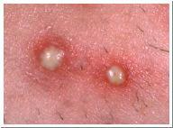 Comedones Milia whiteheads, an accumulation of dead, keratinized cells and sebaceous matter trapped beneath the skin Acne