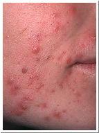 chronic inflammatory congestion of the cheeks & nose Acne
