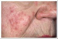 sebaceous glands-often the basis of acne wen or sebaceous cyst