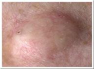 Asteatosis dry, scaly skin characterized by absolute or partial deficiency of sebum boil-a