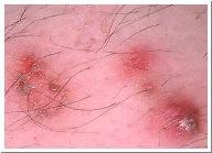 Pimples follicle filled with oil, dead cells, & bacteria inflammation