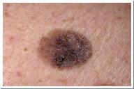 Hyperhidrosis excessive perspiration Miliaria Rubra prickly heat-eruptions of small red vesicles accompanied by burning & itching-caused by excessive heat Hypertrophies Condition/ Disease/Disorder