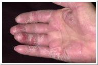 Eczema dry or moist lesions accompanied by itching, burning, & various other unpleasant sensations