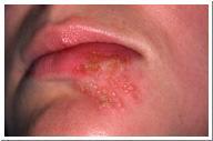 Herpes Simplex Herpes Zoster Allergy Related