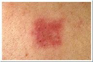 Urticaria hives-inflammation caused by an allergy to