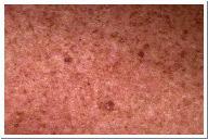 Disease/Disorder Description Macule small, discolored spot