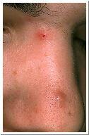Papule small elevated pimple containing no fluid, but may have pus note: yellow or white fatty papules