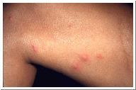 Wheal itchy, swollen lesion that lasts only a few hours ex: mosquito bite Tubercle solid lump larger than