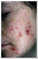 Acne Scars Condition/ Disease/Disorder Description Ice Pick Scar large, visible, open pores that look as if the skin has been jabbed with an ice pick-follicle always