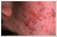 lumpy mass of raised tissue on the surface of the skin-caused where cysts have clumped together