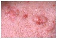 Barber's Itch Tinea Favosa - Honeycomb Ringworm Tinea Unguium - Ringworm of Nails ringworm, due to