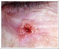 Basal Cell Carcinoma least malignant-most common skin