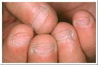 Nail Diseases/Disorders Onychophagy nail