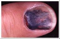 Onychocyanosis blue nail (usually caused by poor circulation)