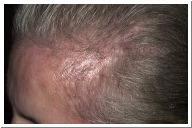 Telogen Effluven hair loss during the telogen phase of the hair growth cycle Canities gray hair Pediculosis Capitis