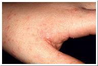 Scabies contagious disease caused by the itch mite