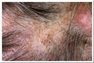 Keloids forms when excess collagen forms at the site of a healing scar-overhealing Asteatosis excessive dry skin Appendix A Georgia State Board of Cosmetology Glossary of Legal Definitions Master