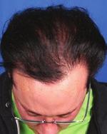 NeoGraft Hair Transplant Happy with His Hair Dimitri, 54 of Palm Springs first noticed hair loss at age 36 and had his first hair transplant then in Beverly Hills.
