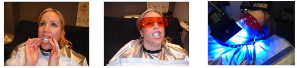 TEETH WHITENING PROCEDURE [CONTINUED] STEP 3: Have the client tear open mouth guard