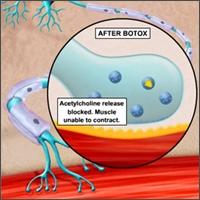 How BOTOX Cosmetic Works Under normal conditions, a neurotransmitter known as acetylcholine is released by the nerve cell.