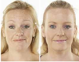 Anti-Wrinkle Treatments With NSC Clinics.