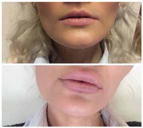 specifically for you. I LOVE my new lips and I am so glad I went for it. After getting it done, I realised how much of a little deal it actually is the dentist was a hundred times worse!
