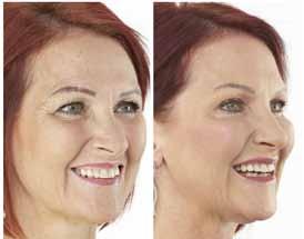 Dermal fillers are the perfect treatment for you when creams are no longer enough, giving you the added confidence that comes with looking and feeling years younger.