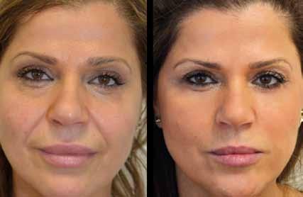 This means the classical youthful V-shape is reversed and becomes more like an inverted V. The treatment method V Soft Lift aims to restore the youthful facial V shape.