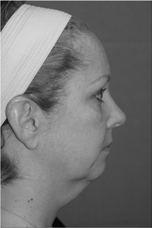 Chin Augmentation Note: Prior to reading this chapter you should have read Parts I and II of this book!