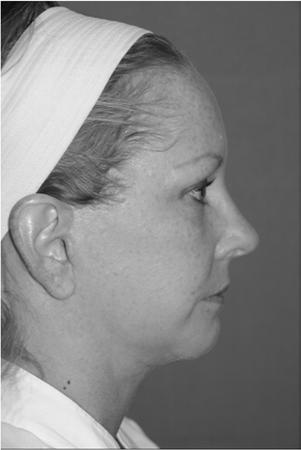 This patient also had face lifting with liposuction at the neck. Mentoplasty Mentum is the Greek word for chin; the suffix plasty means to shape or mold.